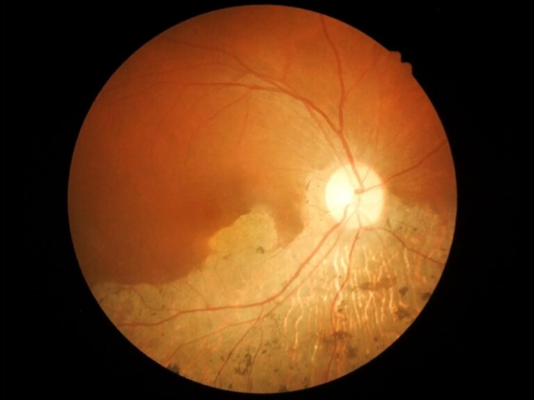 Age Related Macular Degeneration.jpg