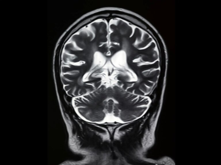 Front Brain Scan Mri Image.jpg