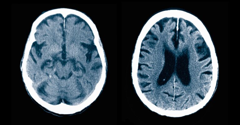 Cognitive Impairment Diagnoses Science 578457691.jpg