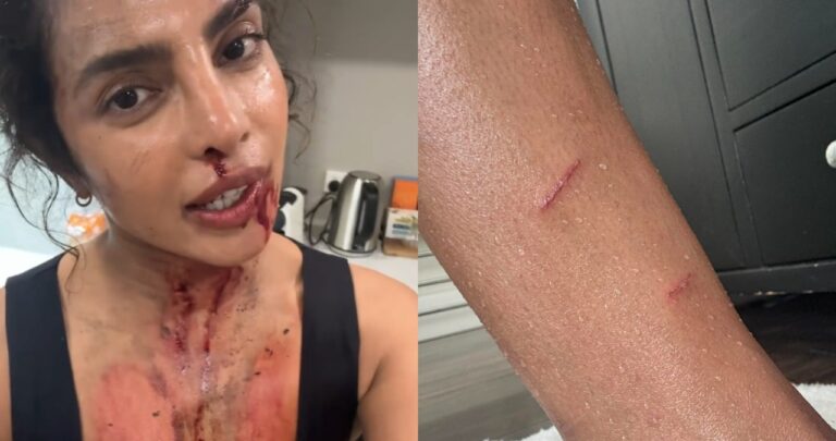 Priyanka Chopra Injuries D4wr.jpg