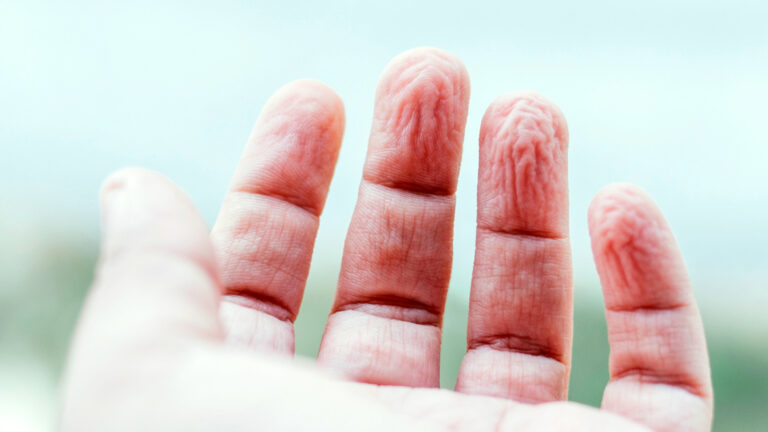 Pruney fingers.jpg