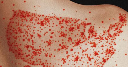 Science measles gettyimages 2163958662.jpg